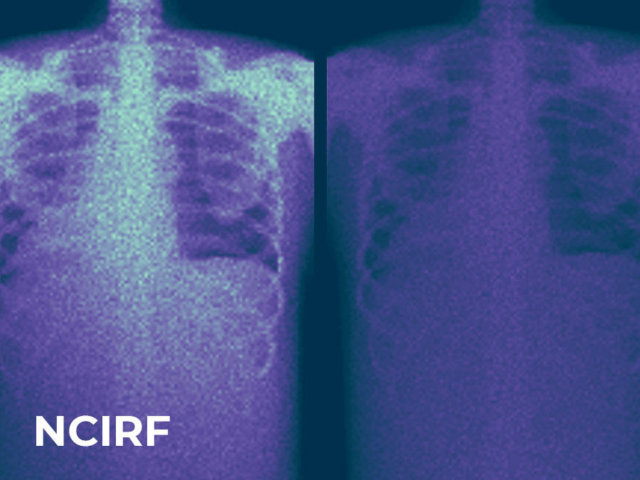 NCIRF text with background of chest and stomach x-rays
