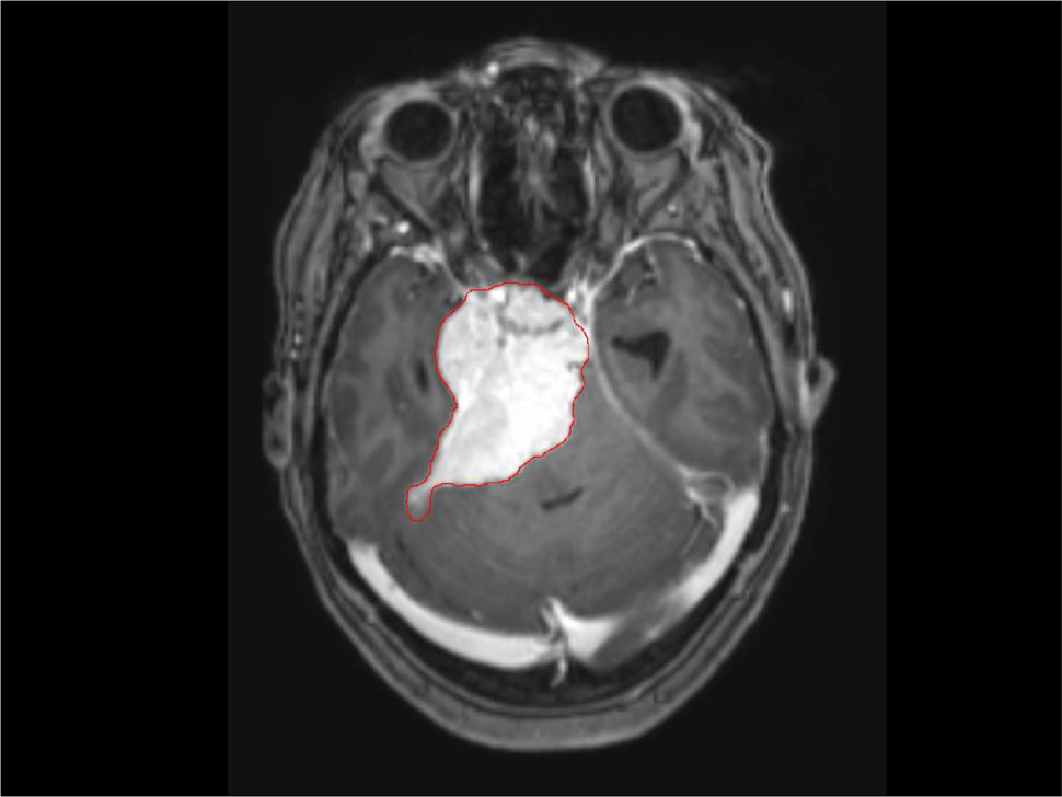 An MRI of a brain with meningioma. The meningioma is identified with a red outline. 