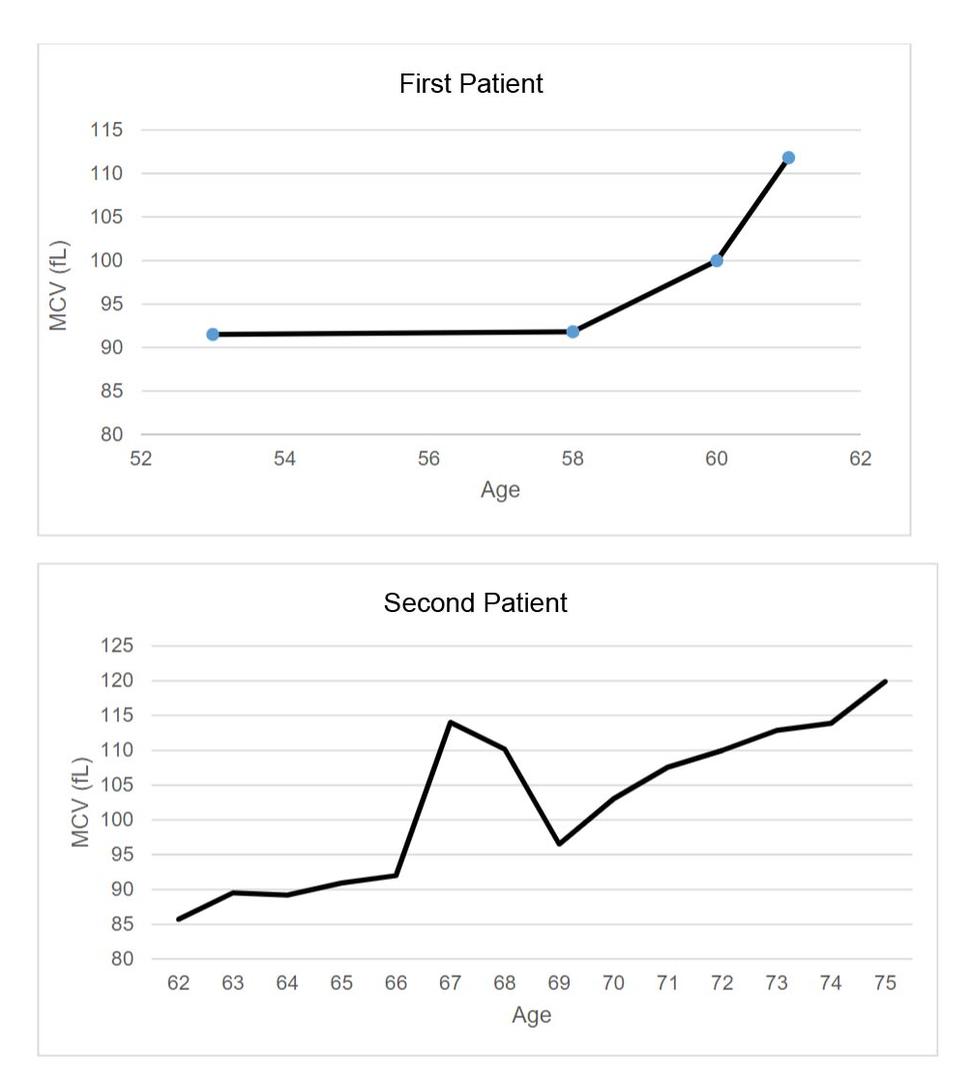 Two line graphs. First patient shows MCV values starting at around 91fL at age 35 to 58, which then increased to 112 fL at age 61. The graph of the second patient shows MCV starting at 85 fL at age 62, steadily increasing to 120 fL at age 75, with a spike to 115-110 fL at ages 67-68.