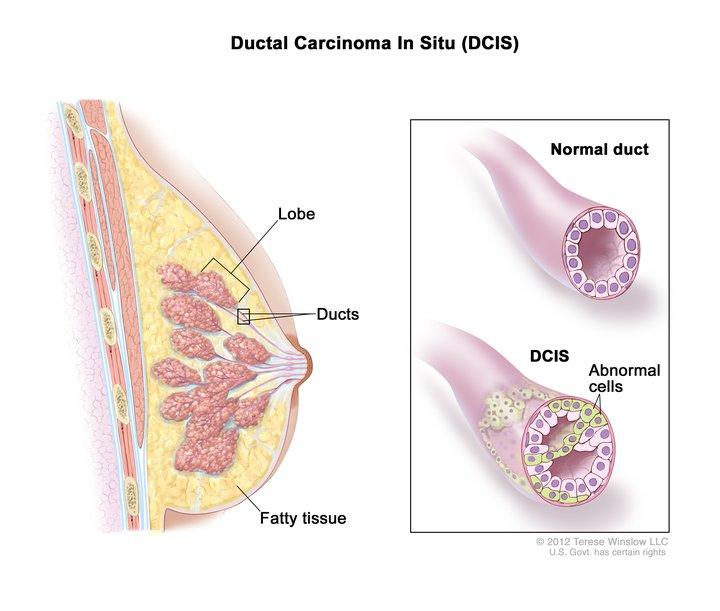   Ductal carcinoma in situ (DCIS); drawing shows a lobe, ducts, and fatty tissue in a cross section of the breast. The inset shows a normal duct and an example of DCIS with abnormal cells in the lining of the breast duct. 