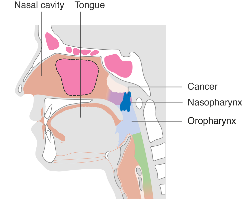 diagram showing stage T2 nasopharyngeal cancer