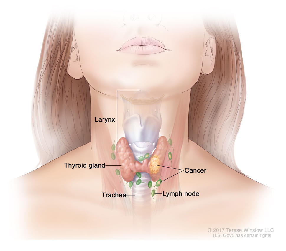 Anatomical drawing of thyroid, lymph node, trachea, larynx, and cancer on the thyroid and lymph node.