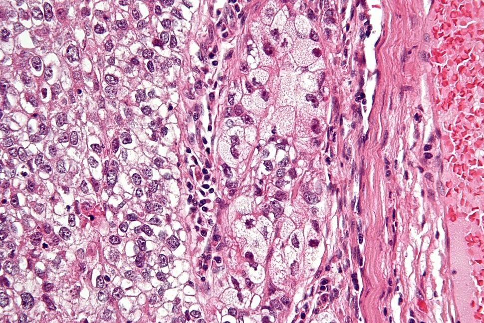 Very high magnification micrograph of a sebaceous tumor with H&E stain (pink and purple).