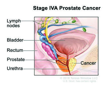 Stage IVA prostate cancer; drawing shows cancer in one side of the prostate and in nearby lymph nodes. The PSA can be any level and the Grade Group is 1 ,2, 3, 4, or 5. Also shown are the bladder, rectum, and urethra.