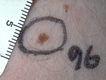 mole on a light skinned person circled in black marker and next to a ruler