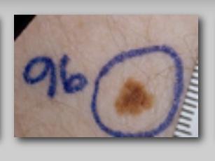 Series of 5 images depicting changes of a dysplastic nevus over time.