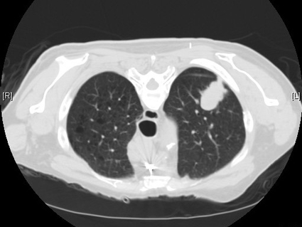 Image of a computed tomography scan of the lungs.