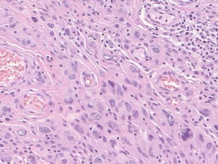 Photo of atypical spitzoid melanoma tissue under a microscope