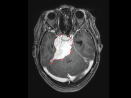 An MRI of a brain with meningioma. The meningioma is identified with a red outline. 