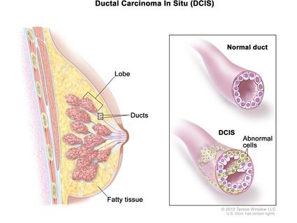  Ductal carcinoma in situ (DCIS); drawing shows a lobe, ducts, and fatty tissue in a cross section of the breast. The inset shows a normal duct and an example of DCIS with abnormal cells in the lining of the breast duct. 
