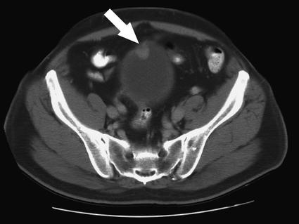 Computed tomography (CT) scan of the bladder showing bladder cancer (arrow).