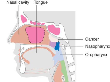 diagram showing stage T2 nasopharyngeal cancer