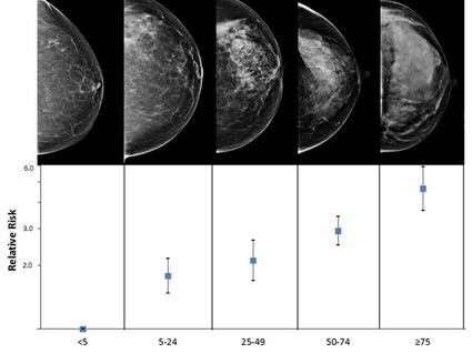 mammograms showing breast density