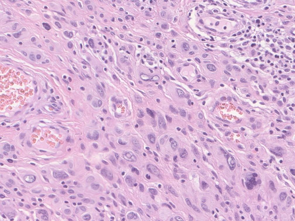 Atypical spitzoid tumor study nci