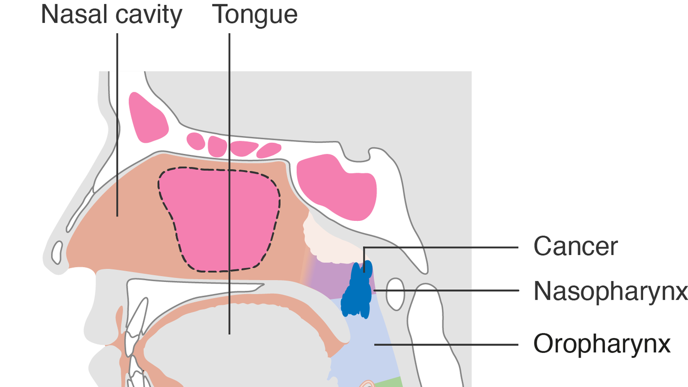 diagram showing stage T2 nasopharyngeal cancer