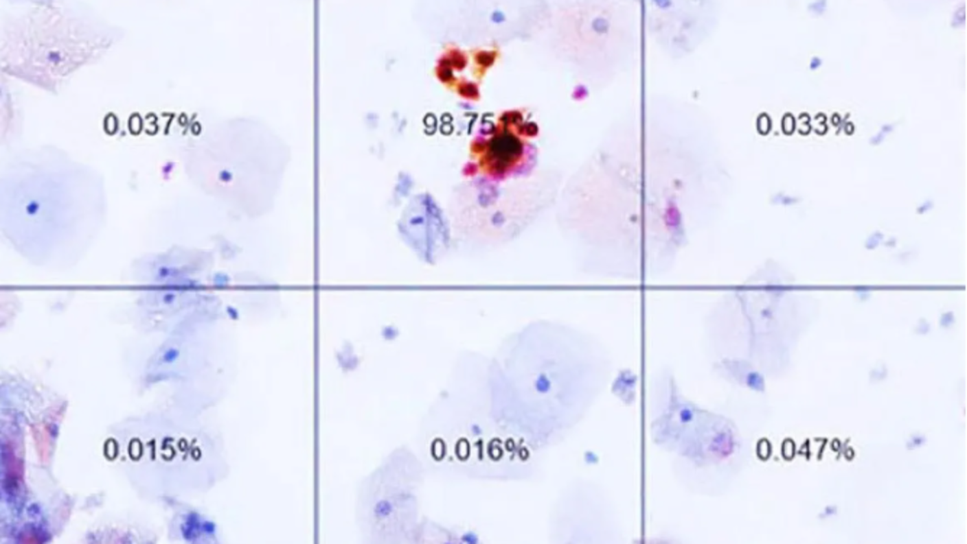 An image from a dual-stain test performed using Dr. Wentzensen’s AI program. It shows the likelihood that cervical cells are cancerous or pre-cancerous. 