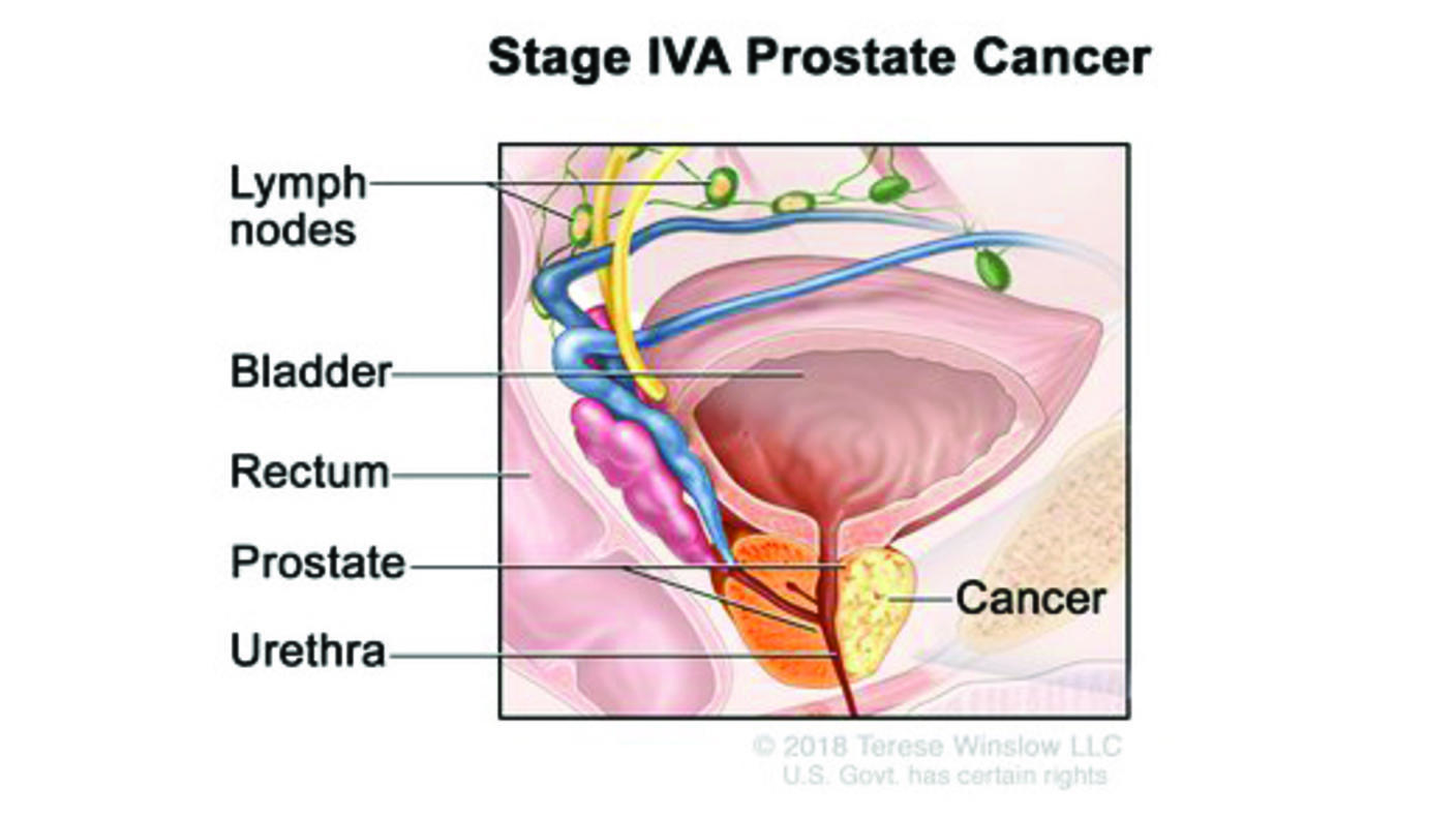 Stage IVA prostate cancer; drawing shows cancer in one side of the prostate and in nearby lymph nodes. The PSA can be any level and the Grade Group is 1 ,2, 3, 4, or 5. Also shown are the bladder, rectum, and urethra.