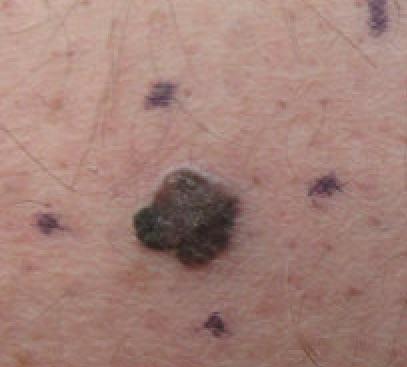 Dark brown spot on fair skin with four markings around it.